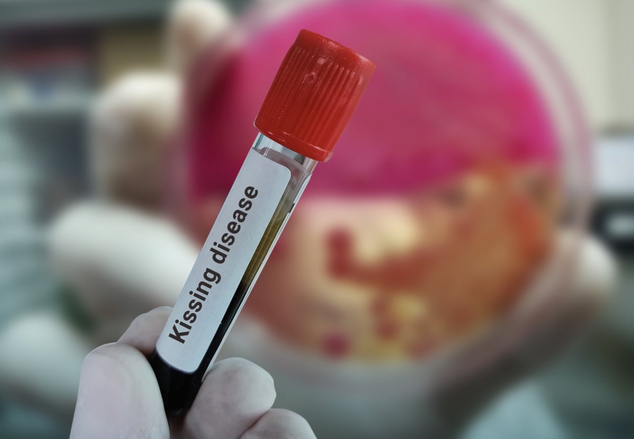 Σκλήρυνση-κατά-πλάκας:-Συνηθισμένη-λοίμωξη-των-νέων-τριπλασιάζει-τον-κίνδυνο